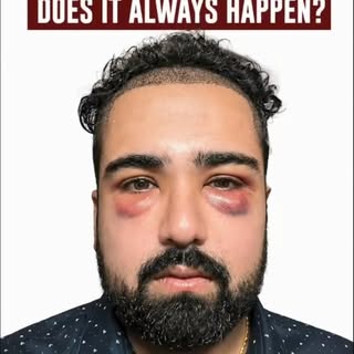After a hair transplant, not all swelling is the same. A small amount of swelling caused by anaesthe