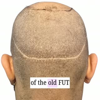 One of the biggest reasons FUE transformed hair transplantation was its approach to scarring. Unlike
