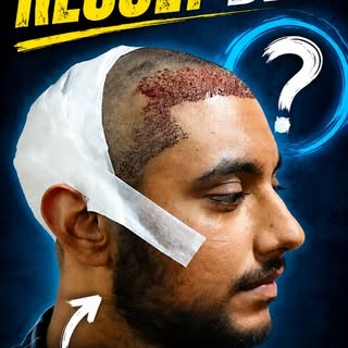 For many young men, hair loss changes far more than the hairline. It alters the way the entire face 