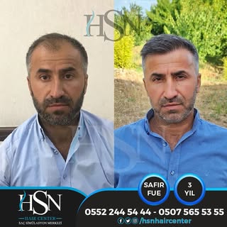 Sevgili Mesut Bey'in yeni ve doğal görünümü sizlerle.. 
Kendisine bizi tercih ettiği için teşekkür e