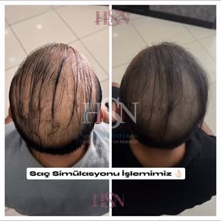 Saç simülasyonu 4. Seans sonucumuz ( Yıkanmış Saç ) 
Mikro iğnelerle yapılan, dökülme bölgelerini ka