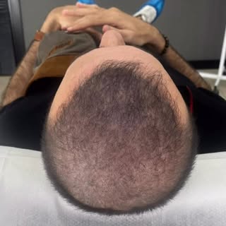 SAÇ SİMÜLASYONU ;
• Saçın seyrek olan bölgelerine uygulanan 3 boyutlu gölgelendirme tekniğidir
• ⁠Sa