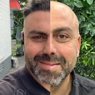 Kaybolan yıllarınızı değil ama kaybolan saçlarınızı verebiliriz. 😎 

- Saç ekimi, kaybettiğiniz saç