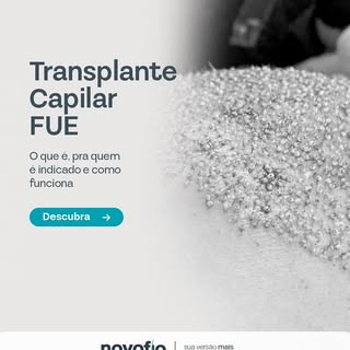 Você já ouviu falar sobre o transplante capilar FUE?
Essa é a técnica mais moderna do mercado, com f