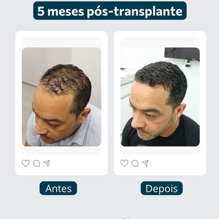 Transformação em apenas 5 meses! 😱 Confira o resultado incrível do transplante capilar realizado na