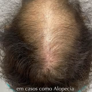 Se você achava que o Transplante Capilar só era para homens, você está muito enganado! Muitas mulher