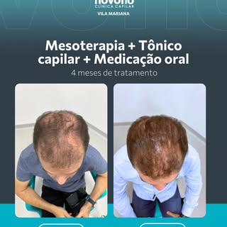 Em apenas 4 meses de tratamento, já é possível observar uma evolução importante na densidade e na co