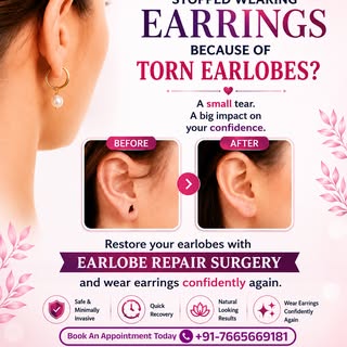 ✨ Bring Back Your Confidence with Earlobe Repair Surgery! ✨

Torn or stretched earlobes don't have t
