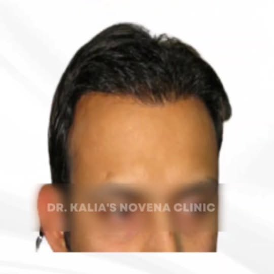 Get the best results for Hair Loss at Dr. kalia's NOVENA Clinic. Call: 8146266227

https://drkalia.c