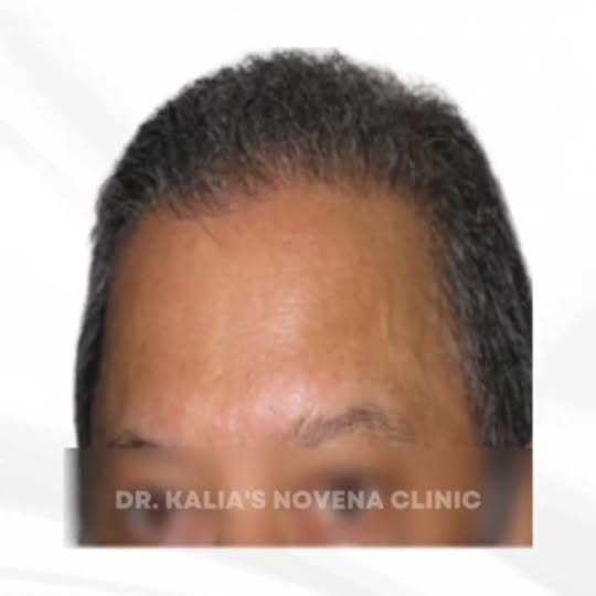 CAll US : +91 81462 66227
➡️ www.drkalia.com | drdeepakkalia@gmail.com

#hairtransplantinChandigarh 