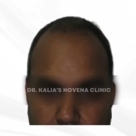 Get the best results for Hair Loss at Dr. kalia's NOVENA Clinic. Call: 8146266227

https://drkalia.c