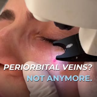 Dark, visible veins around the eyes can make the under-eye area look tired and aged. Periorbital vei