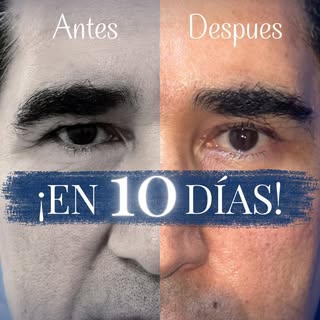 ¿En solo 10 días? 😦
Cuando llegó a mi consulta, me dijo que sentía que su rostro había envejecido 