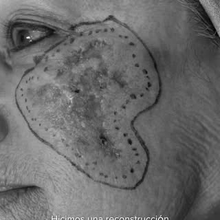Hace más de seis años tratamos un carcinoma basocelular en la mejilla de nuestra paciente Ramona. Ho