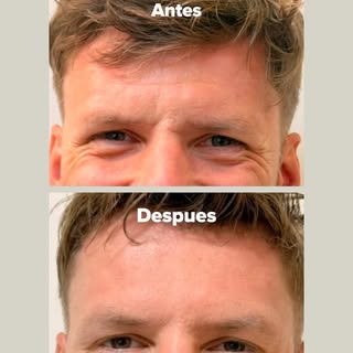 El antes y después de @danielzhero . 

Con Sculptra, buscamos estimular la producción natural de col