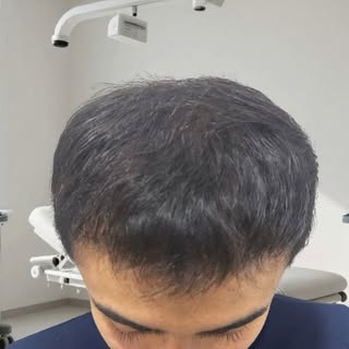 Kliniğimizde gerçekleştirdiğimiz her saç ekim operasyonunda, hastalarımıza en doğal ve kalıcı sonuçl