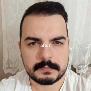 Öncesi ➡️ sonrası ✨
Doğal görünüm hedeflenerek planlanan bir saç ekimi uygulaması

Sonuçlar kişiden 