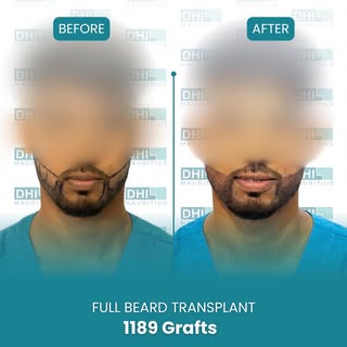 Complete beard transformation with natural lines and only one-day procedure. Start your beard journe