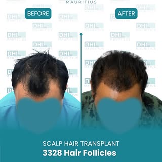 6 months. 3,328 hair follicles. One confident new look. 
Natural-looking hair restoration designed t
