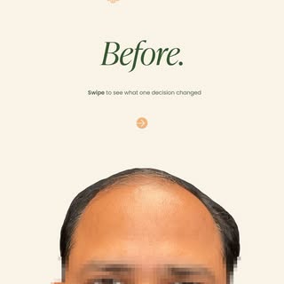Before. After.
No filters. No angles. Just one hair transplant and time.
This is what we see every s