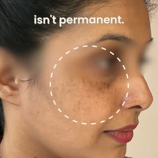 That patch on your face isn't permanent. 🎯
Most pigmentation — melasma, dark spots, sun damage, pos