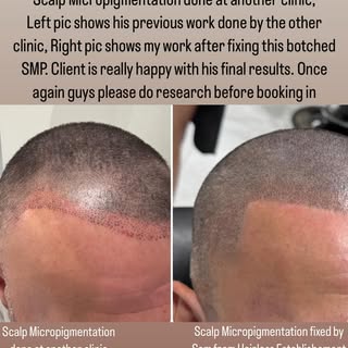 This client done Scalp Micropigmentation done at another clinic, as you can see in the left photo, i