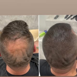 Before & After Scalp Micropigmentation.
Price ranges from $1000-$4000 depending on how much area we 