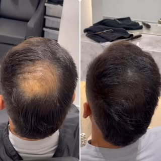 Scalp MicroPigmentation is a procedure used to cover Hairloss with instant guarenteed results. 
We a