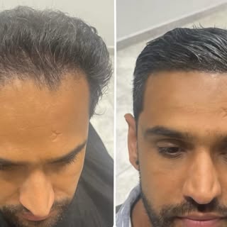 Before & After Hair MicroBlading. 
Not happy with your hairline? We can help fix it.
This procedure 