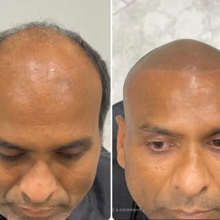Before & After Scalp Micropigmentation.
Price ranges from $1000-$3500 depending on how much area we 