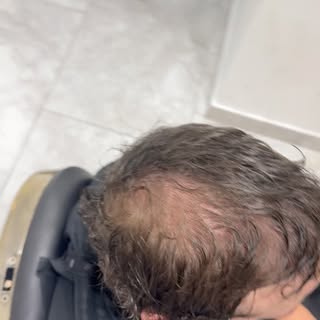 Before & after Scalp Micropigmentation.
1st video shows the difference between the half that’s been 