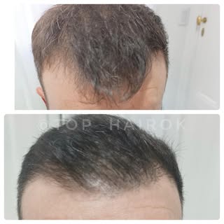 😷Implante capilar técnica FUE
.
👆🏻Evolución post implante de 4 meses
.
❕ya se observa un abundant
