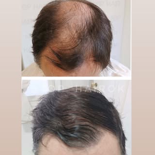 ❕❕11 meses post #implantecapilar 
.
😷 técnica FUE zafiro, pelo por pelo sin cicatrices
.
📍Tandil, 