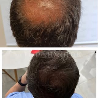 🗒️ 8 meses de evolución post #implantecapilar #tecnicafue 
.
🙌🏻 gracias a nuestros pacientes por 