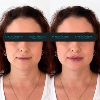 #curvylips💋💋💋 #dudakdolgusu #dudakdolgusui̇stanbul #dudakdolgusuataşehir #lipfilleristanbul