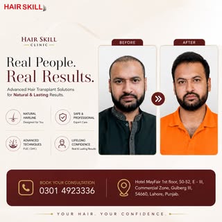 Real People. Real Results. Real Confidence. ✨

Hair restoration is more than just regrowing hair — i