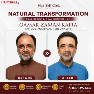 Experience a powerful natural transformation with Hair Skill Clinic, the hair transplant experts. We