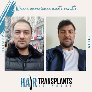 Embark on a transformative journey with Hair Transplants İstanbul! 🌟 This image is a testament to t