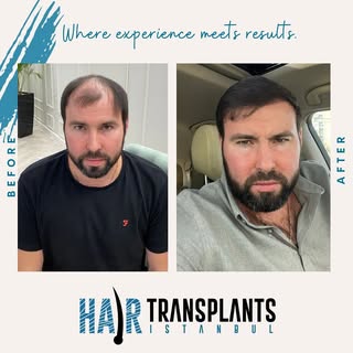 Revitalizing roots: Unveiling the incredible journey of hair restoration, where every before has an 