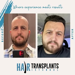 Transformation Tuesday: From thinning to thriving! 🌟 Witness the incredible journey of our patients