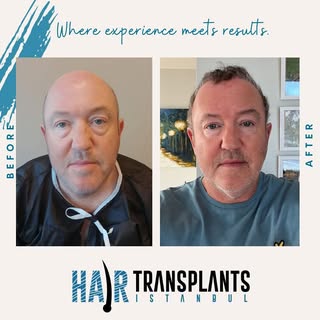From thinning to thriving! Witness the amazing transformation after our expert hair transplant proce
