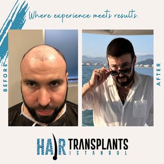 From subtle beginnings to standout results. 🌱 🤩

#hairtransformation #hair #hairtransplant #hairtr
