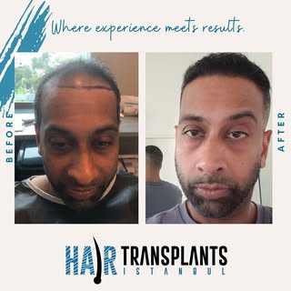 Journey from subtle to standout 🌱. Witnessing our patients' incredible transformations, one strand 