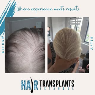 Real Results, Real Confidence 
This beautiful woman came to us with very thin hair and a limited don
