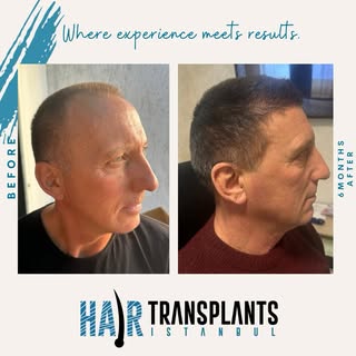 6-month update. The change is clear, and the density is building up nicely. Still more to come. 

🥳