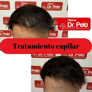 Resultados reales: Rigor médico y medicina capilar avanzada en Clínicas Dr. Pelo. 
Os mostramos la e