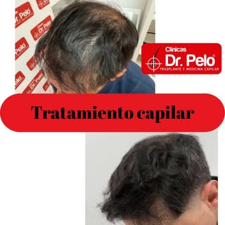 Resultados reales: Rigor médico y medicina capilar avanzada en Clínicas Dr. Pelo. 
Os mostramos la e