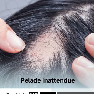 La pelade se manifeste par des plaques rondes sans cheveux. C’est une maladie auto-immune qui peut ê