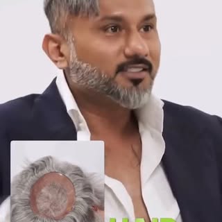 "I am totally bald, this is fake hair... it's a hair system."

Hair loss affects millions of men, bu