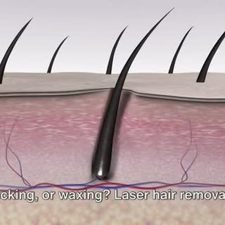 Laser Hair Removal offers a smooth, hairfree future with minimal fuss. This advanced treatment targe